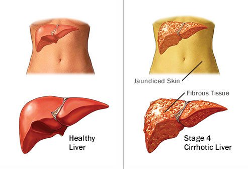 Long-tern effects of alcohol on the body include liver disease. 