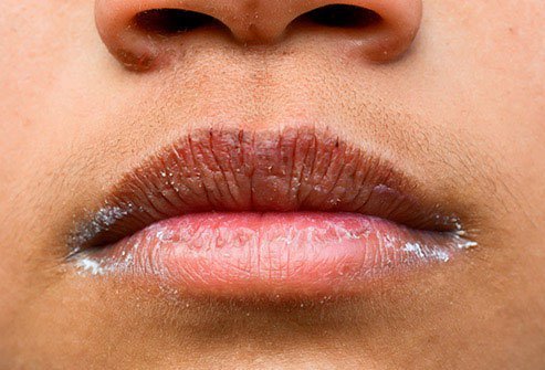Your mouth could get dry and cracked at the corners as your body draws fluid from it.