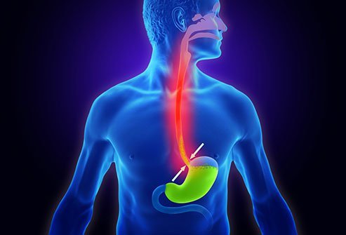 Gastroesophageal reflux disease or GERD is caused by the weakening of the lower esophageal sphincter