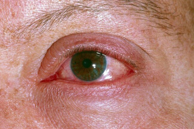 About a third of people in the hospital for COVID-19 get conjunctivitis, which you might know as pinkeye.