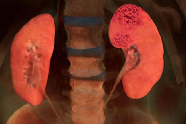 This is common in people who are seriously ill from COVID.
