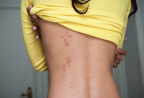 bug bites