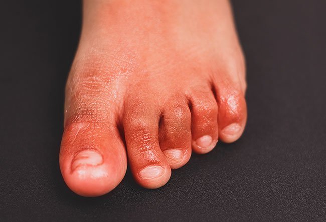 chilblains