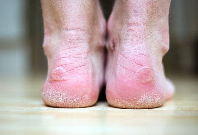 Blisters are fluid-filled skin lesions. They are caused by burns, contact dermatitis, friction and certain medical conditions. Blisters are fluid-filled skin lesions. They are caused by burns, contact dermatitis, friction and certain medical conditions.