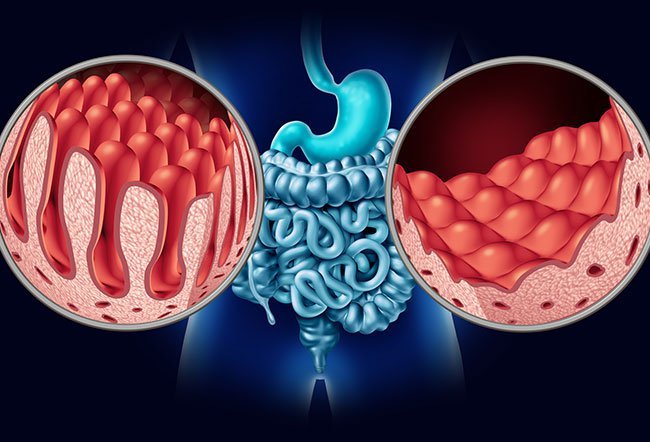 Malabsorption is when your body has trouble digesting food and absorbing nutrients. Common symptoms include bloating, weight loss, fatigue, muscle weakness, abdominal discomfort, bad smelling stools, rashes, swollen feet and hands, and nausea and vomiting. 
