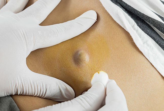 Sebaceous cysts sometimes go away by themselves, but they may remain indefinitely. If one remains for more than two weeks and you feel it needs to be treated, talk to your doctor. 