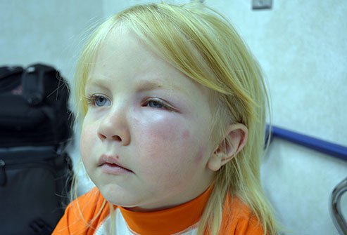 Swollen eyelid Swollen eyelid
