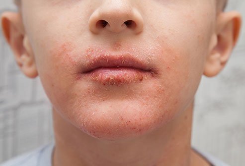 Perioral Dermatitis Perioral Dermatitis