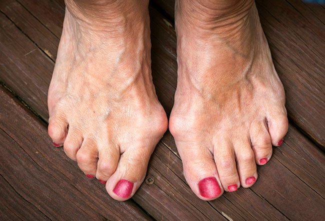 bunion bunion