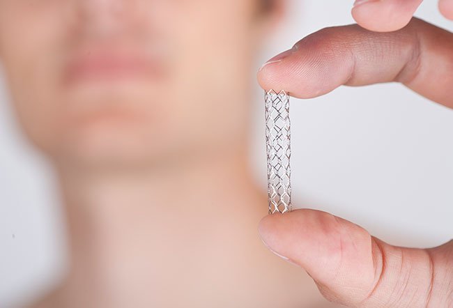 Once a stent is placed in a carotid artery, the stent permanently stays inside the artery. 