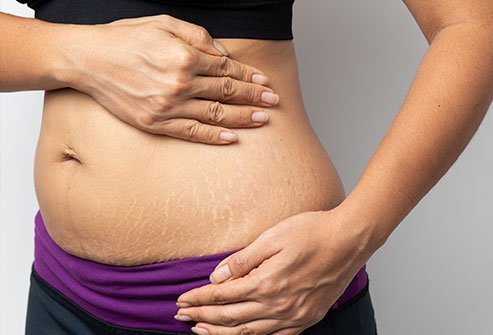 Home remedies and doctor prescribed treatments may help diminish the appearance of stretch marks.