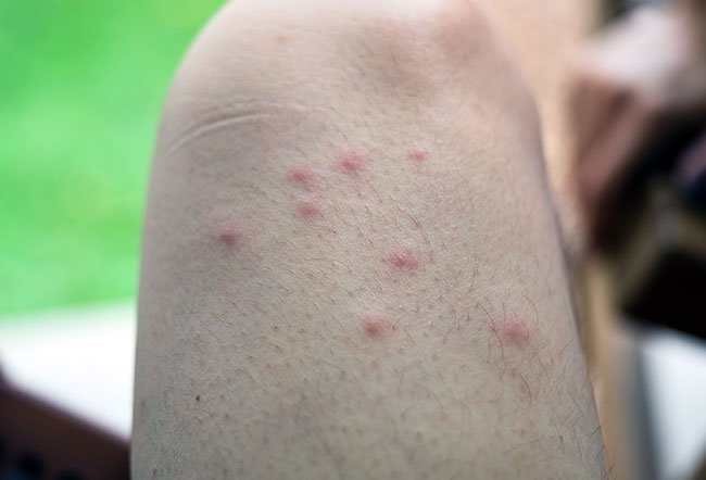 There are a few ways to determine whether you have a spider bite rather than a mosquito bite.