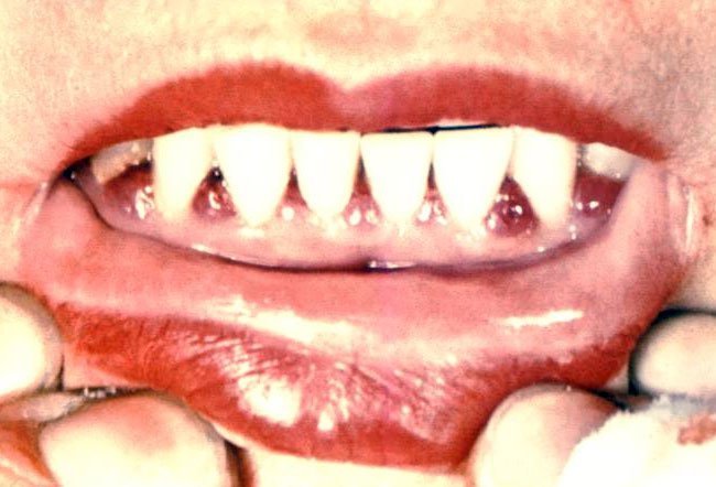 Scurvy is usually treated with a diet change, vitamin supplements, or an ascorbic acid injectable.