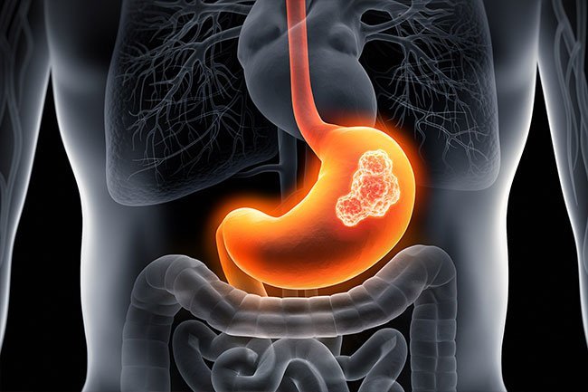 A, AB, and B blood types are more at risk for stomach cancer than type Os.