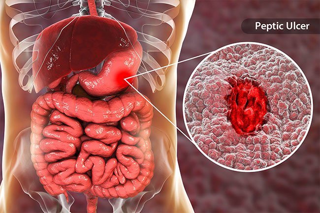 Peptic ulcers seem to occur more often in people with type O blood. 