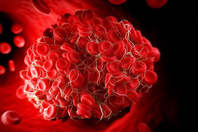 People with type A, B, or AB blood are at a higher risk of venous thromboembolism (VTE).