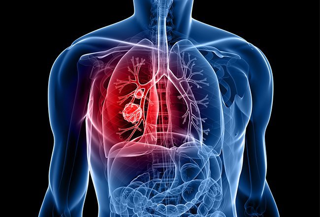 what are the stages and survival rates of NSCLC what are the stages and survival rates of NSCLC