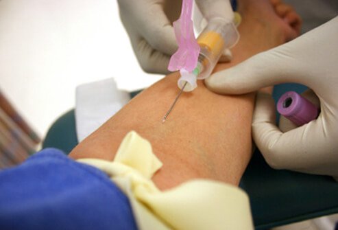 If your doctor suspects hyperthyroidism, diagnosis is made through a blood test to measure TSH levels in your blood.