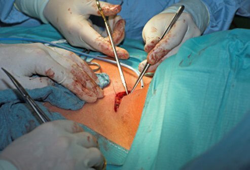 Doctors performing surgery on a patient with hyperthyroidism.