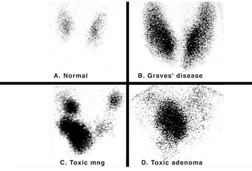 Hyperthyroidism is caused by Graves disease, excessive iodine, and thyroiditis.