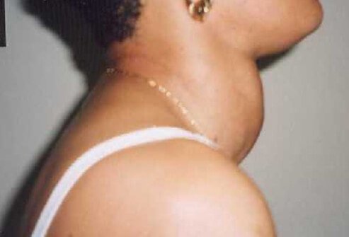 When the thyroid gland tissue overgrows, either in individual nodules (the functioning adenoma) or in multiple clusters (multinodular goiter), it is generally termed a