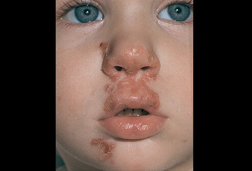 Picture of Impetigo
