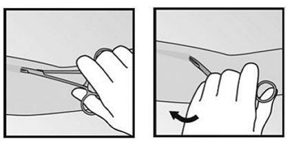 Anesthetize the site, for example, with 0.5 to 1
mL 1% lidocaine, where the incision will be made - Illustration