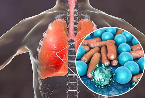 inflammation of the lungs inflammation of the lungs
