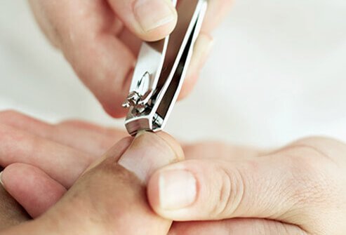 Ingrown toenails occur most commonly as a result of trimming toenails improperly.
