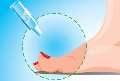 Several over-the-counter treatments for ingrown toenails are available.