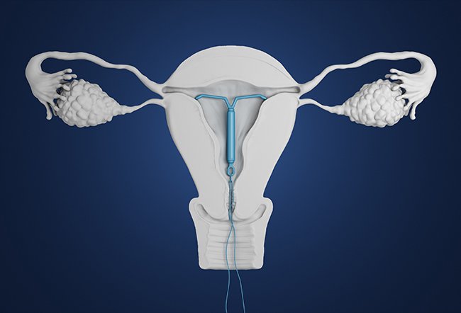 ParaGard IUD