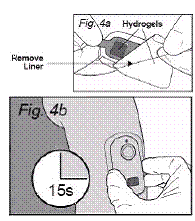 Apply IONSYS to Patient - Illustration