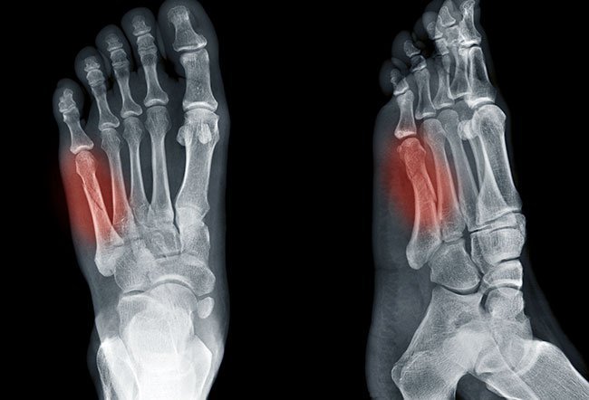 Jones fracture vs avulsion fracture
