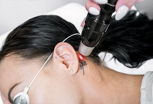 Tattoos may be lightened but cannot be completely removed. Faint scars remain for life.