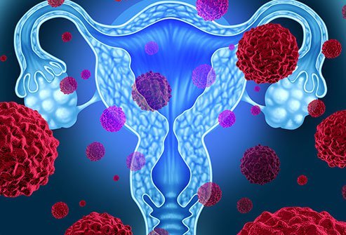 In more than 90 percent of women, unexpected abnormal vaginal bleeding is the most common early sign of uterine cancer.