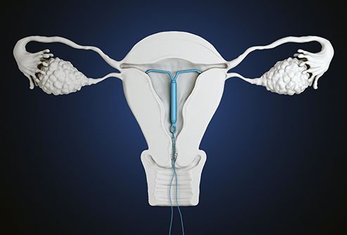 Some women experience mild pain and discomfort when having an IUD placed.