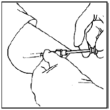 Gently advance the implant with the obturator - Illustration