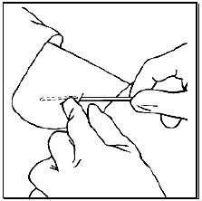 Release of the implant can be checked by palpation - Illustration
