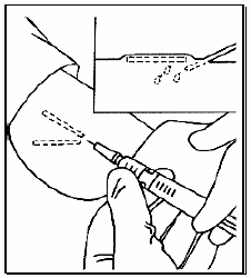 Apply a small amount of local anesthetic - Illustration