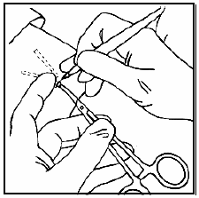 Use the scalpel, the other forceps, or gauze to very gently open the tissue sheath - Illustration