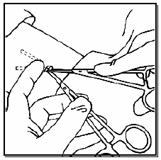Grasp the proximal end of the implant with the second forceps and gently remove it - Illustration