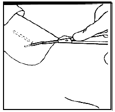 Grasp the proximal end of the implant with the second forceps and gently remove it - Illustration