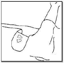 Clean the patient’s upper arm with antiseptic solution and then frame the insertion area with a fenestrated drape - Illustration