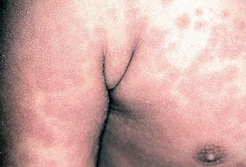 A non-blistering rash is one of the clinical features of Kawasaki disease.