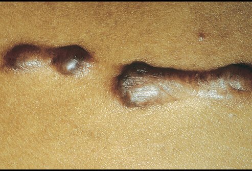 Picture of Keloid