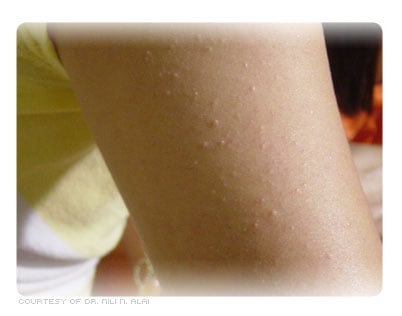 What does keratosis pilaris look like?