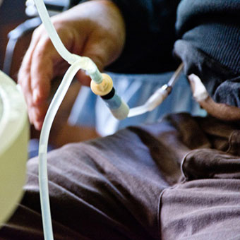 Peritoneal dialysis tubing is attached to the abdominal connection of a male patient.