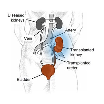 Illustration of a kidney transplant.