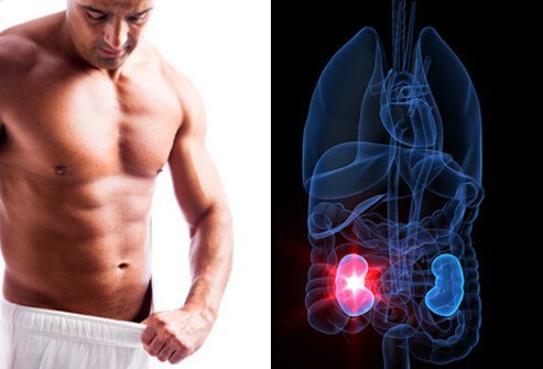 The rate of people who develop kidney stones is increasing in the U.S.