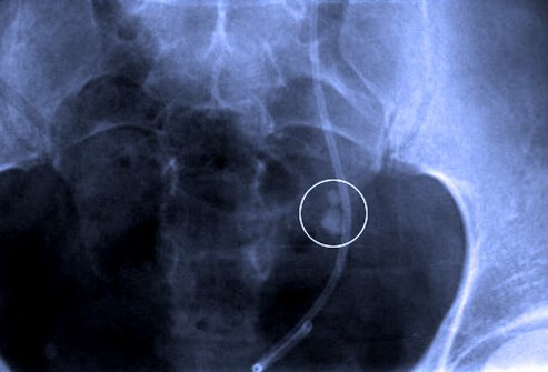 Kidney stones are diagnosed by excluding other possible causes of abdominal pain and associated symptoms.